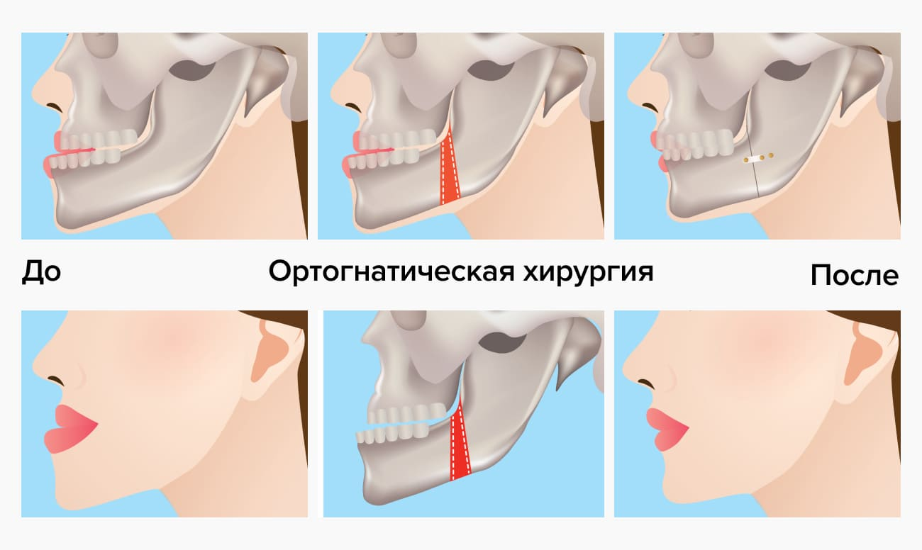 Ортогнатическая операция: основные аспекты. Стоматология Дентал Макс в  Москве у метро Кузьминки