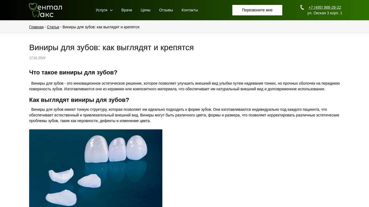 Виниры для зубов: как выглядят и крепятся. Стоматология Дентал Макс в ...